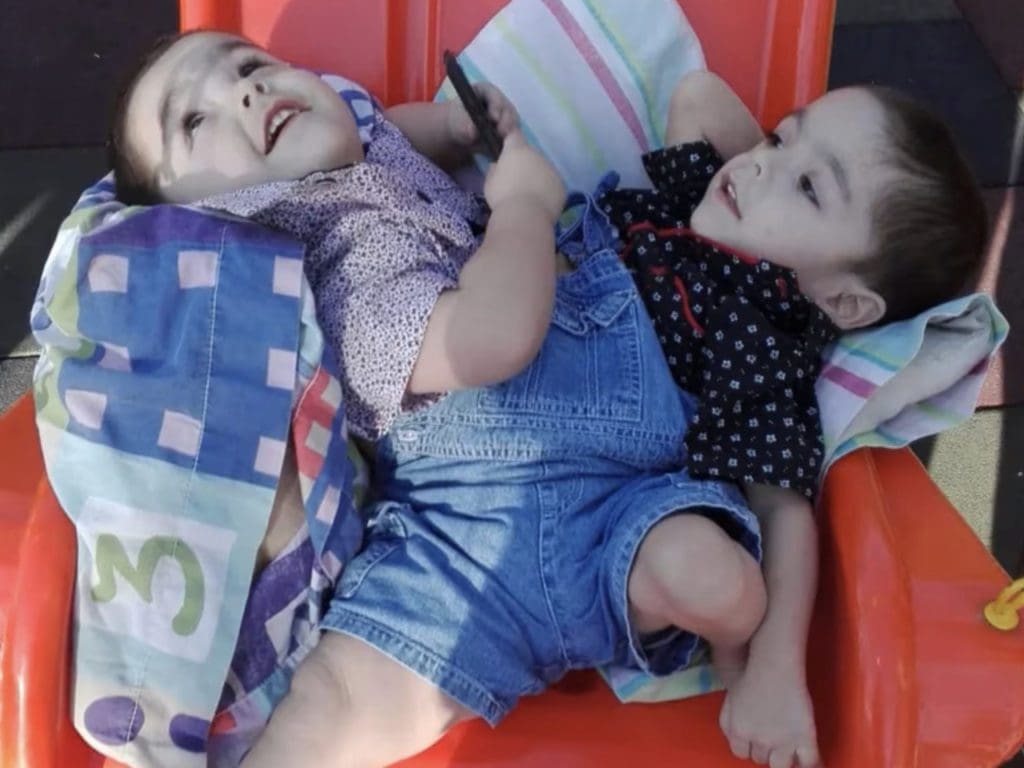 Conjoined twins Agustín and Gael were born on March 17, 2016, with a grim prognosis. Despite the odds stacked against them, they survived and grow stronger with each passing year.